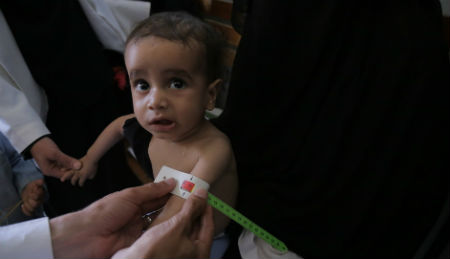A child being treated in Yemen.